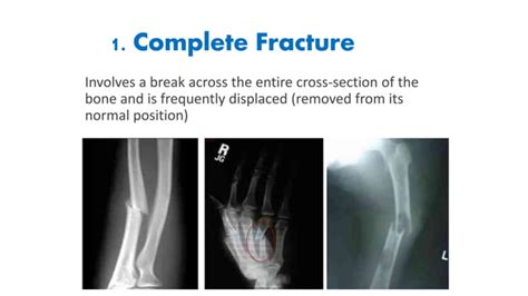 Musculoskeletal Conditions Fractures