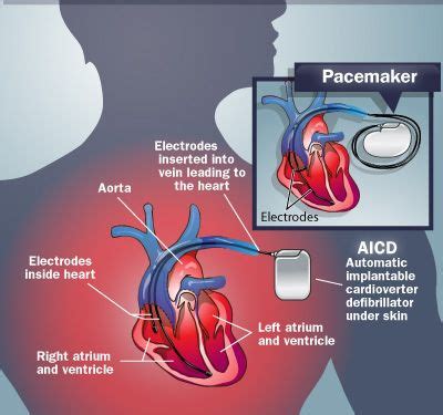 Be sure to avoid being in close proximity to the objects below for extended periods of time. implantable cardioverter defibrillator | Commercial EMF ...
