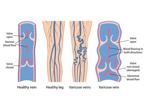 Varices Chirurgie Vasculaire Et Endocrinienne