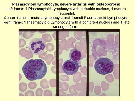 Plasmacytoid Lymphocytes Vs Plasma Cells