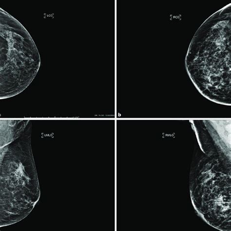 Mammogram Done On October 2019 Showing Diffuse Skin Thickening