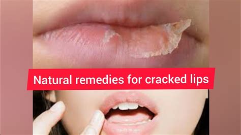 How To Heal Cracked And Chapped Lips In Home Natural Remedies Youtube