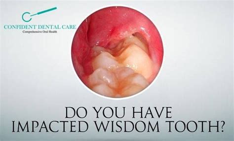 Do You Have A Impacted Wisdom Tooth What Are Symptoms Of Impacted