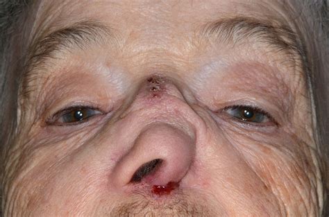 ‘saddle Nose Deformity Caused By Advanced Squamous Cell Carcinoma Of The Nasal Septum Bmj