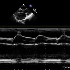 M Mode Echo Of Mitral Valve In A Patient With Mitral Stenosis And