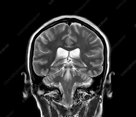 Normal Brain Mri Stock Image C0261176 Science Photo Library