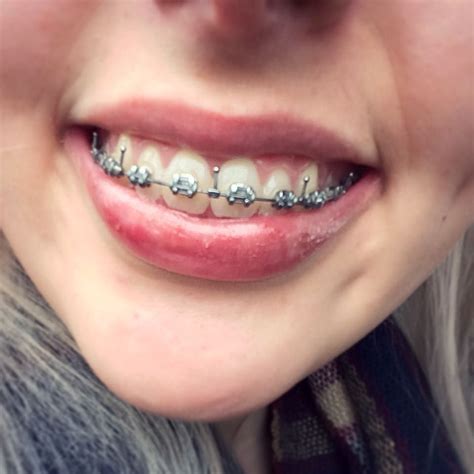 braces girlswithbraces metalbraces hooks orthodontics braces braces colors metal braces