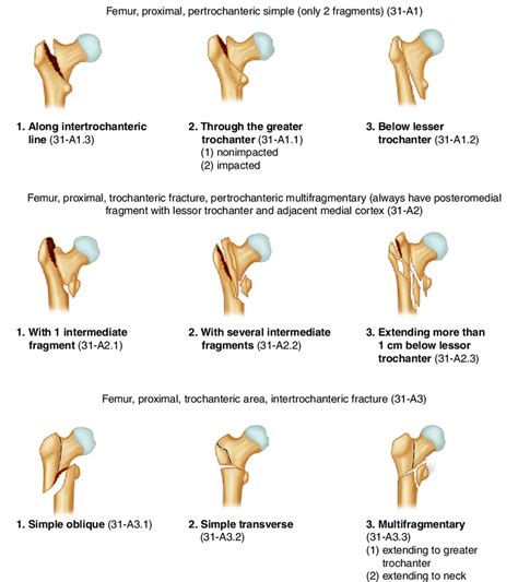 3 Aoota Classification For Trochanteric Fractures Reproduced With