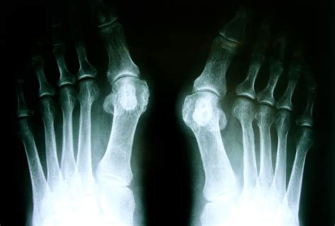 Bunion Surgery Treatment Get Rid Of Bunion Pain Perth Foot Centre