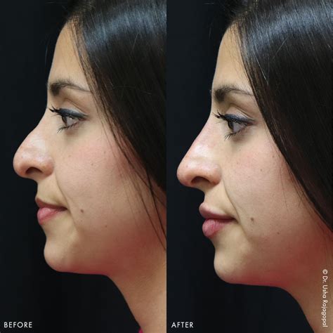 Non Surgical Nose Job After Care Kyle Cone