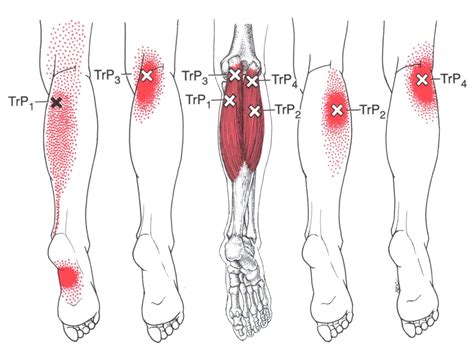 Knee Pain Gastrocnemius The Trigger Point Referred Pain Guide Can