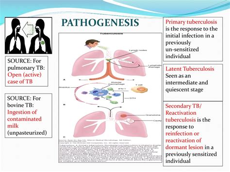 Ppt Tuberculosis Transmission And Pathogenesis Powerpoint Porn Sex Picture