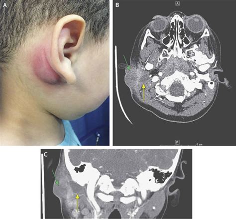 Branchial Cleft Cyst Causes Types Signs Symptoms Diagnosis And Treatment