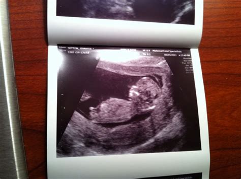 Week 12 Ultrasound Fetal Nuchal Translucency Test Via Ultrasound