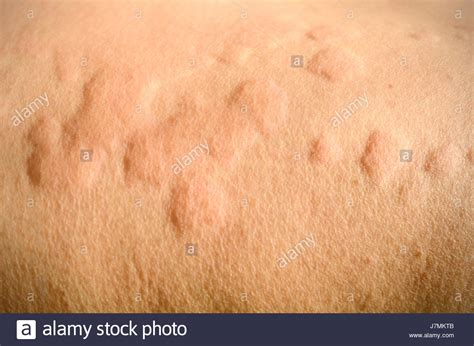 Skin Rash Urticaria Allergic Skin Reaction Stock Photo Royalty Free Image 142440155 Alamy