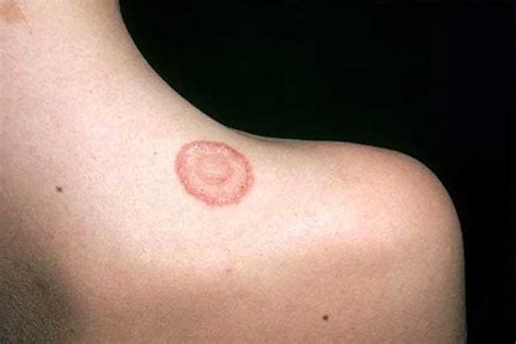 Home Remedies For Ringworm Will Help You To Quickly Cure And Prevent