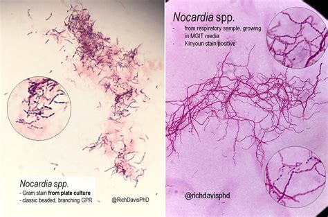 Nocardia On Culture And Respiratory Microscopy Gram Grepmed