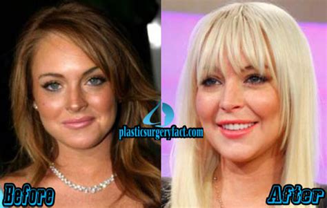 Lindsay Lohan Plastic Surgery Before And After Photos