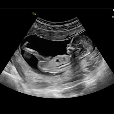 13 Week Ultrasound Femme
