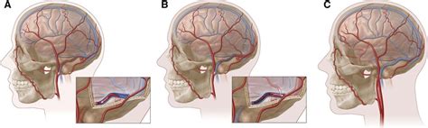 Intracranial Dural Arteriovenous Fistulae Stroke
