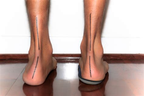Treatment For Flat Feet Pes Planus Perth Foot Centre
