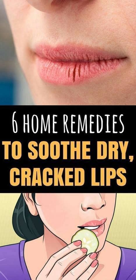 6 Home Remedies To Soothe Dry And Cracked Lips Dry Cracked Lips Dry Lips Cracked Lips