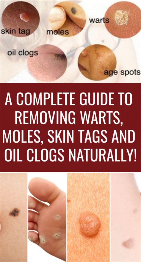 Pin On How To Remove Warts