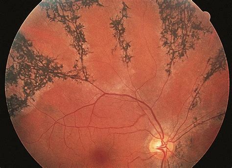 Pigmented Paravenous Retinochoroidal Atrophy American Academy Of