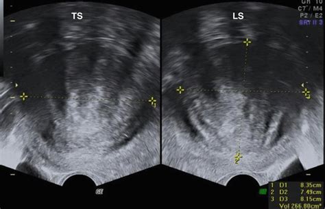 Ultrasound Evaluation Of Myometrium Obgyn Key