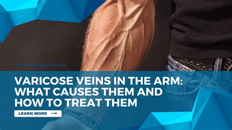Varicose Veins In The Arm Causes And How To Treat Them St Johns Vein