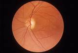 Pictures of Optic Nerve Neuropathy Treatment