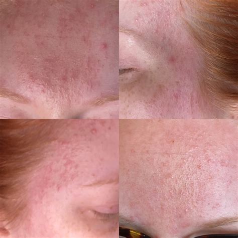Sudden Acne Rash Possible Rosacea General Acne Discussion By