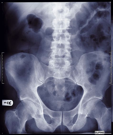 Human Pelvis X Ray Bild Kaufen 13227009 Science Photo Library