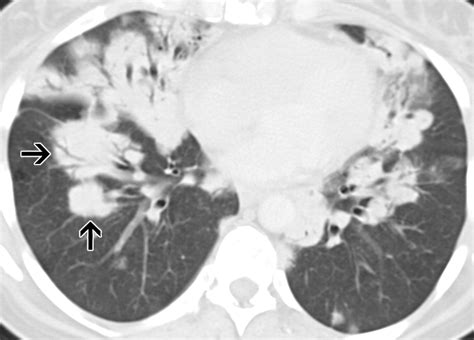 Primary Pulmonary Lymphoid Lesions Radiologic And Pathologic Findings