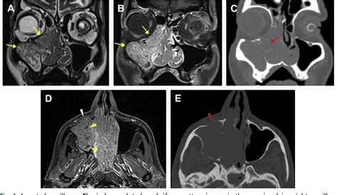 Figure From Sinonasal Tumors Computed Tomography And Mr Imaging