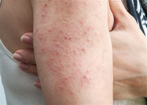 Why Is My Skin So Dry Itchy And Rough The Low Down On Eczema Dr