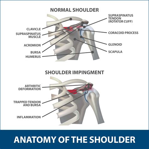 Shoulder Impingement Diagnosis