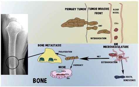 Cancers Special Issue Targeting Bone Metastasis In Cancer