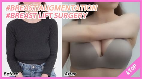 Breast Lift Surgery And Augmentation With Implants Before And After