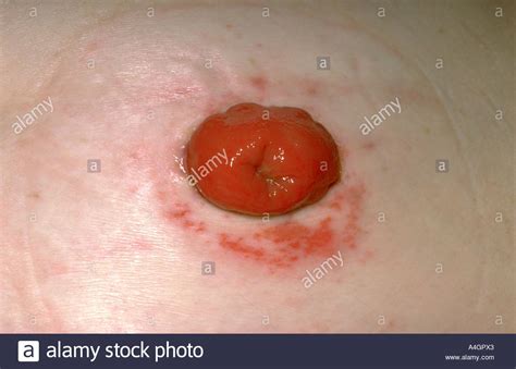 A Photograph Of A Colostomy Stoma An Artifical Opening