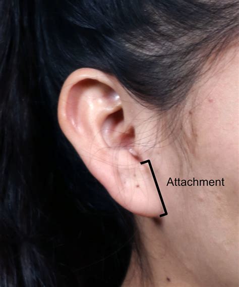 Ear Lobe Attached
