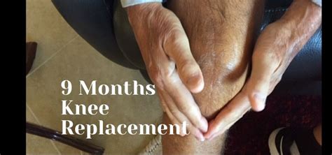 Months After Total Knee Replacement