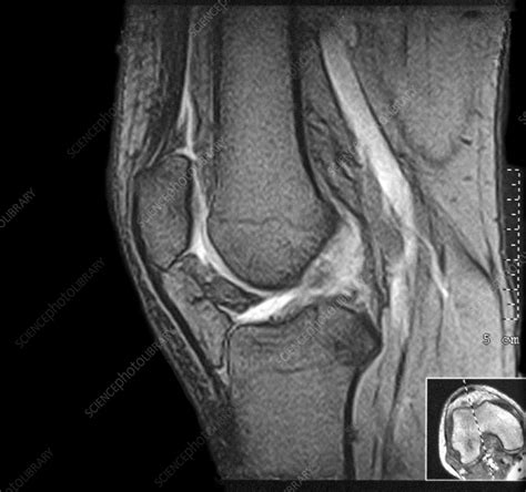 Knee Joint Mri Scan Stock Image C0021301 Science Photo Library