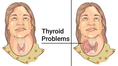 Thyroid Diseases Pictures