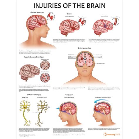 Laminated Injuries Of The Brain Chart Brain Trauma Poster