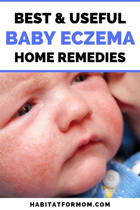 Best Remedies For Baby Eczema Ultimate List Baby Eczema Remedies