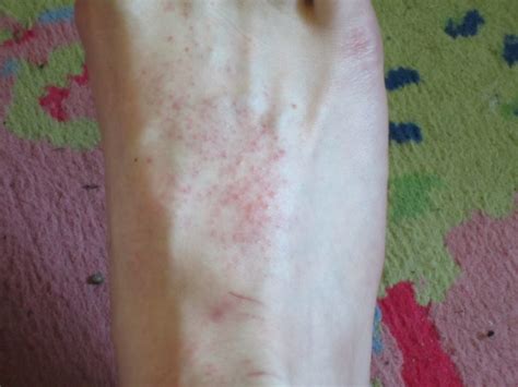 Foot Rash Top Of Foot Pictures Photos