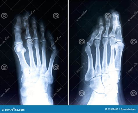 X Ray Of Foot Fingersradiography With Deformed Toeshallux Valg Stock