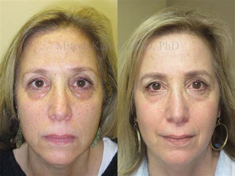 Co2 Laser And Chemical Peel Before And After Photos Boston Eyelids