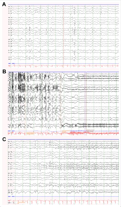 A The Electroencephalogram Eeg Pattern In Panel A Shows Interictal